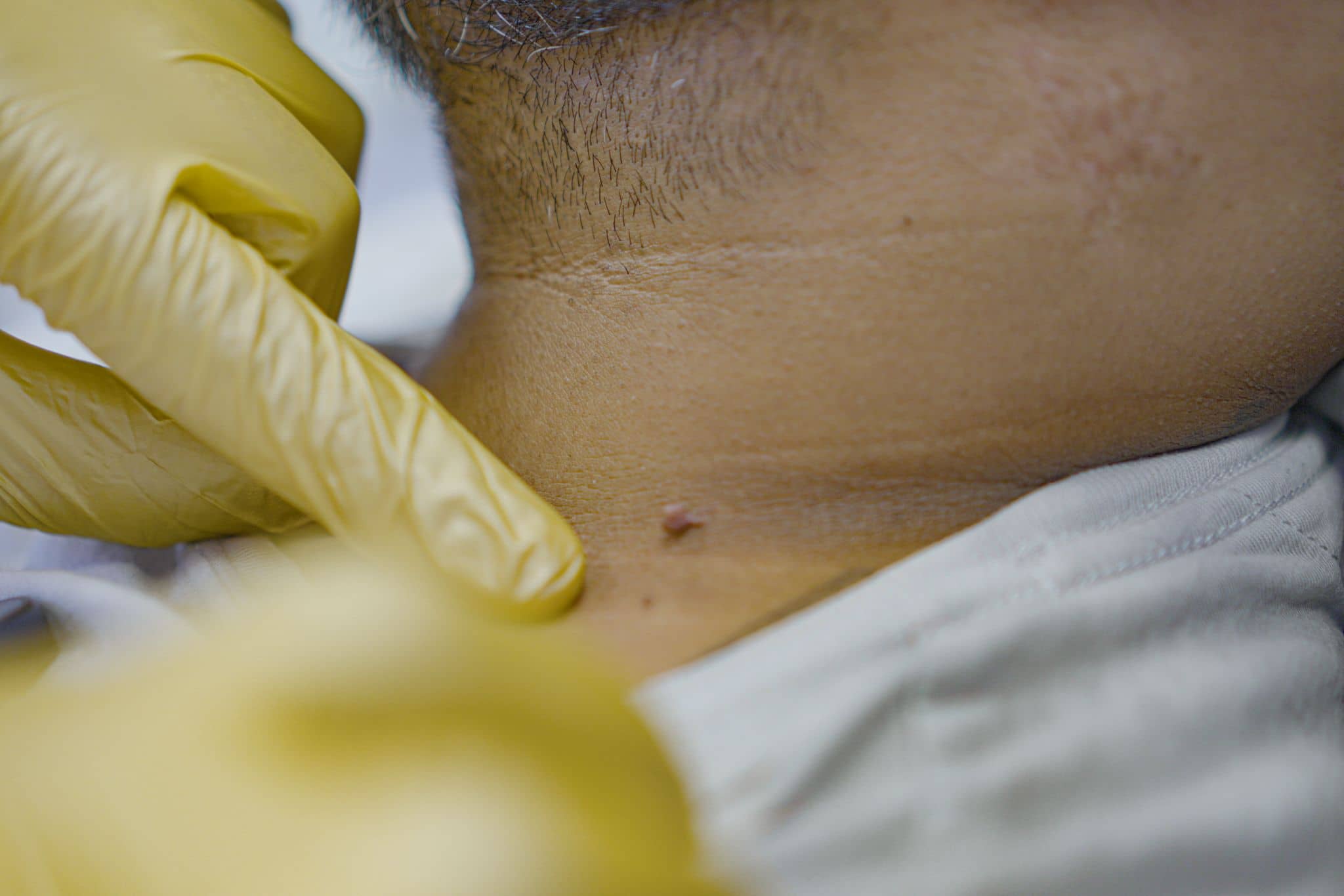 Skin Tag, Mole & Wart Removal