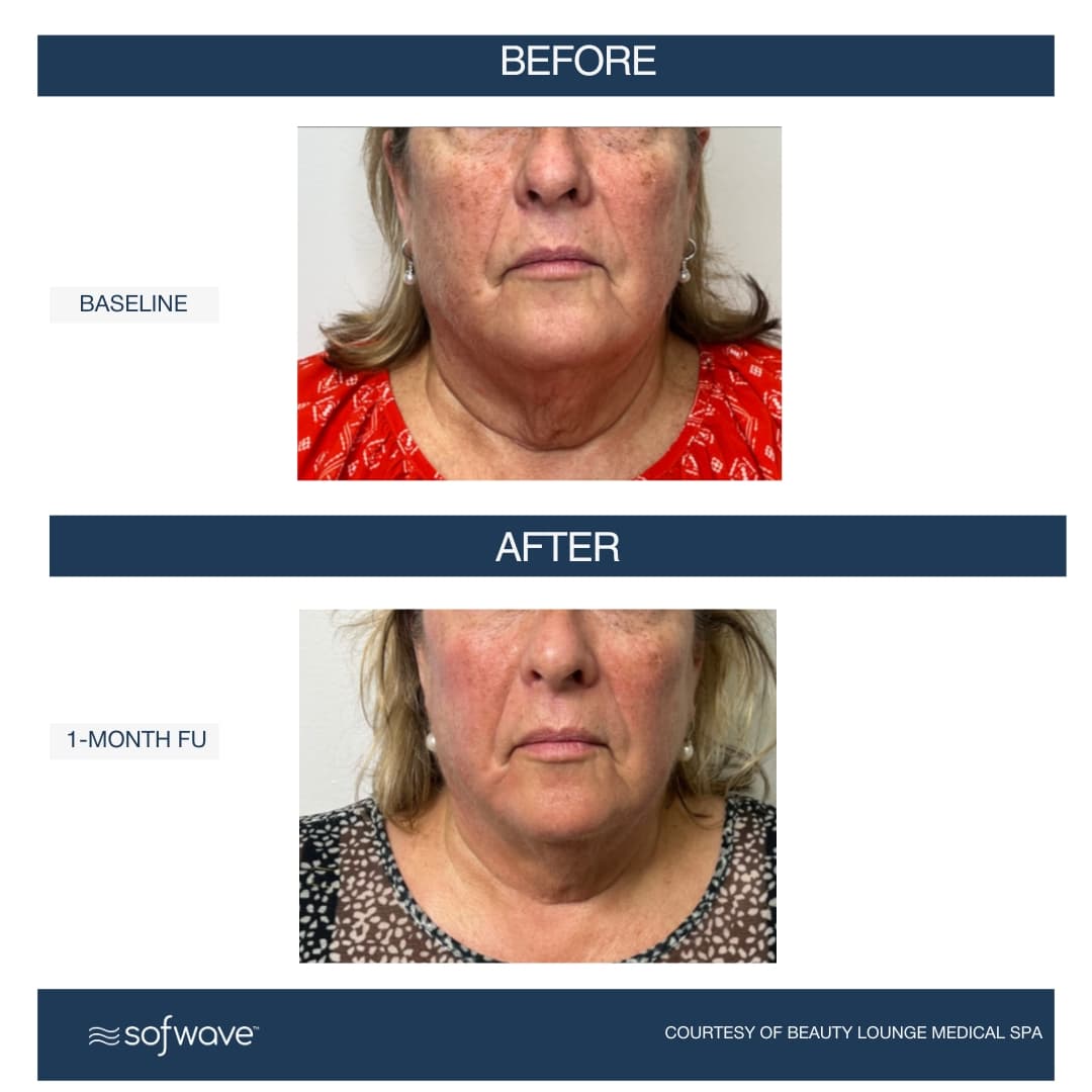 Full Face & Neck Treatment