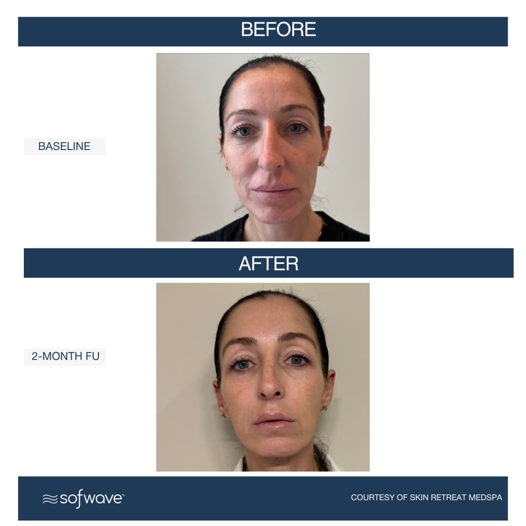 Lower Face & Eyebrows