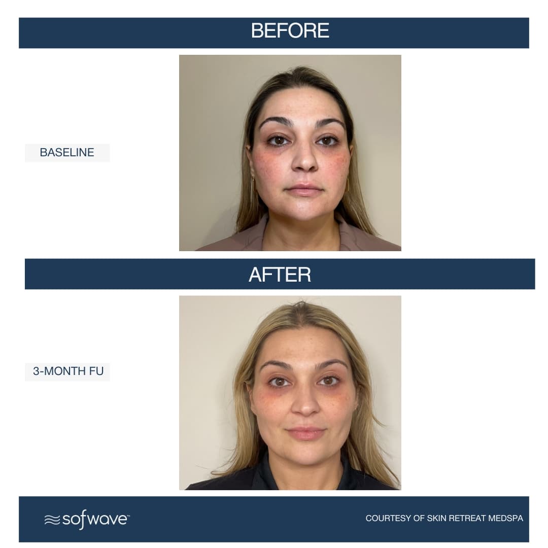 Lower Face & Submentum