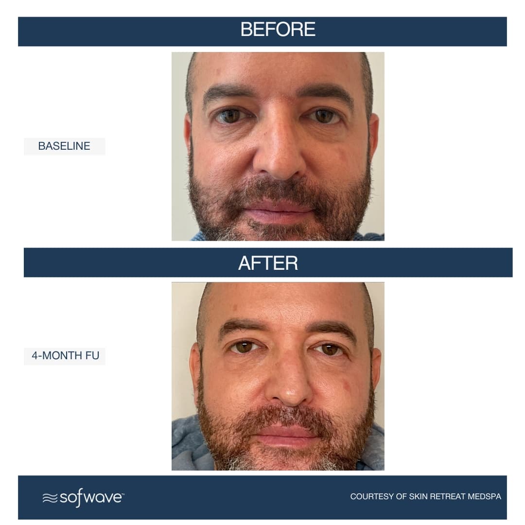 Under Eyes Treatment