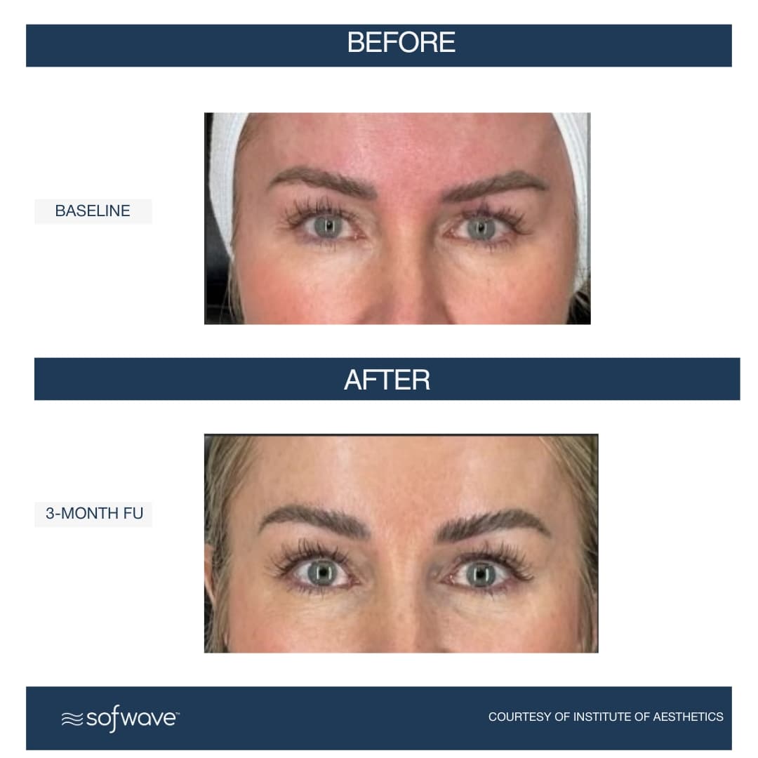 Eyebrow Lift