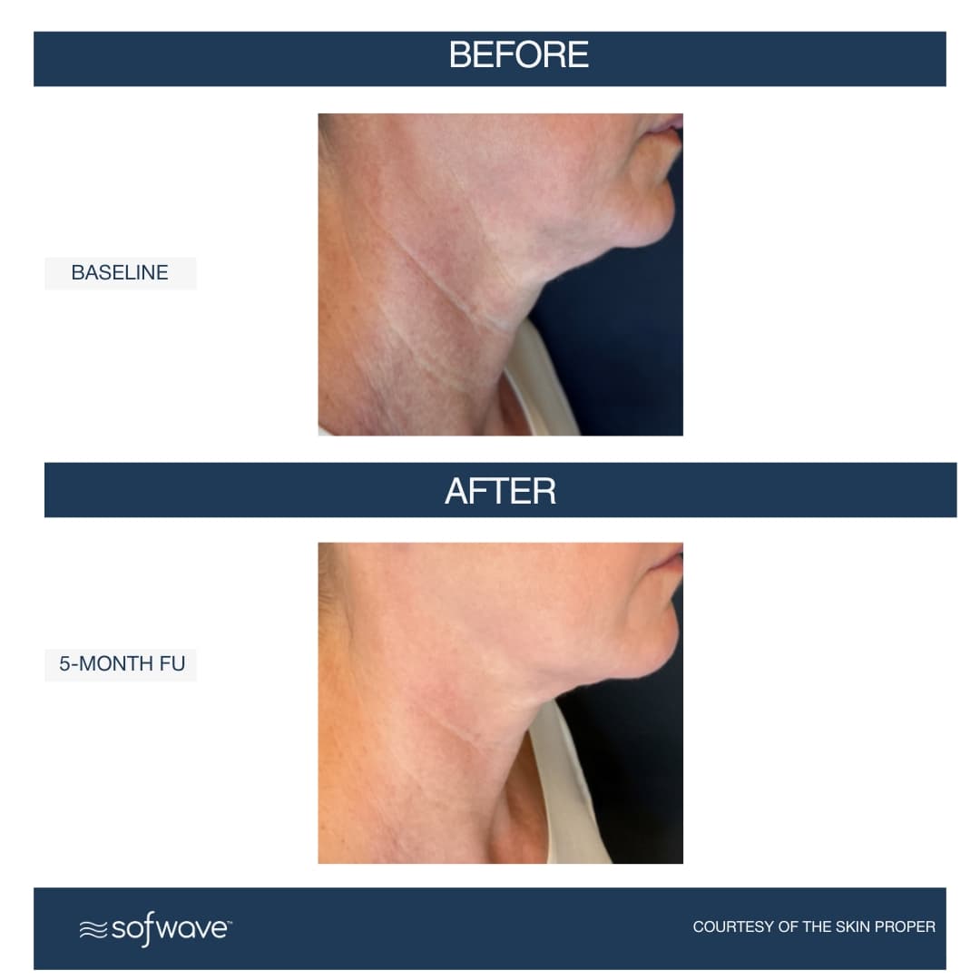 Lower Face & Neck