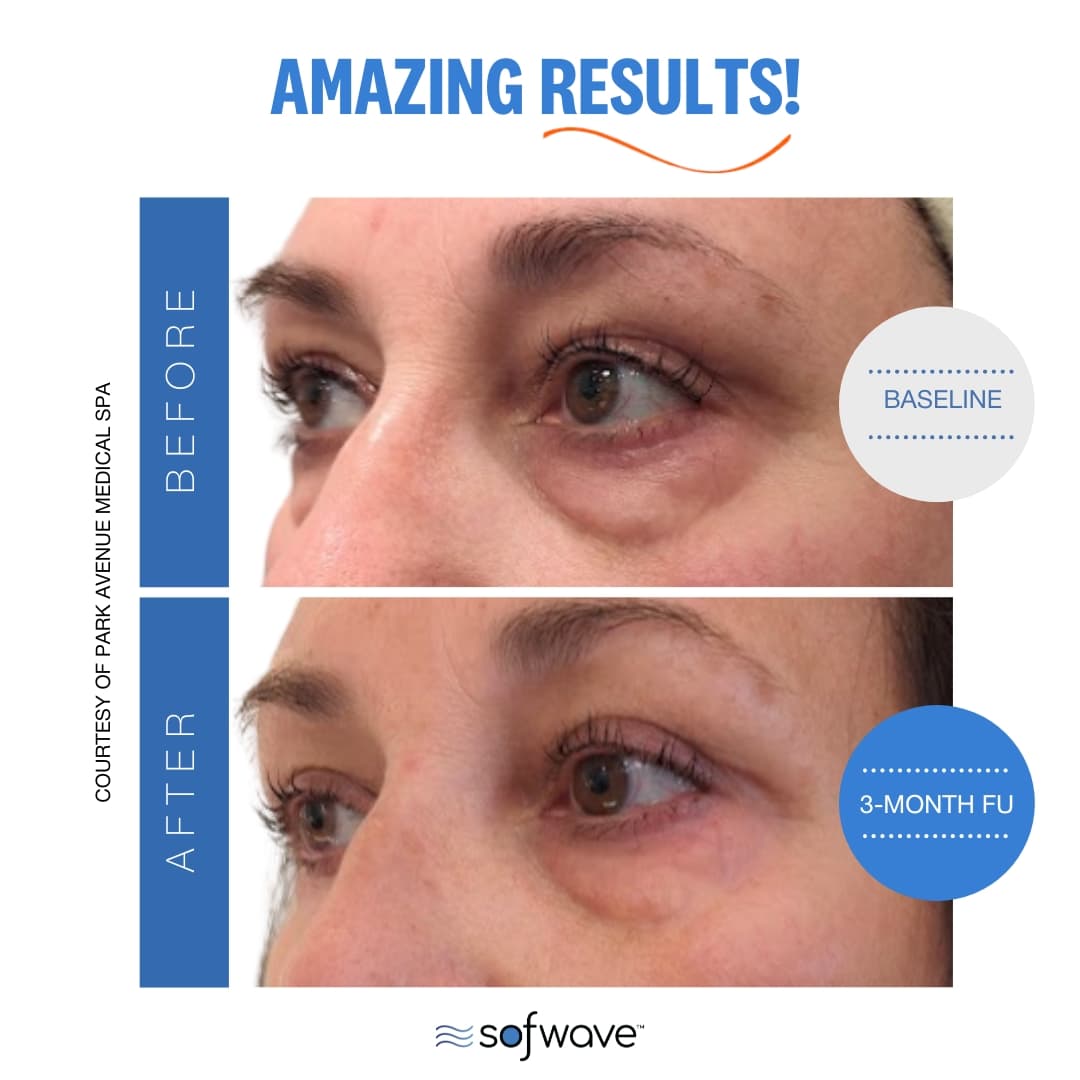 Eyebrow Enhancement