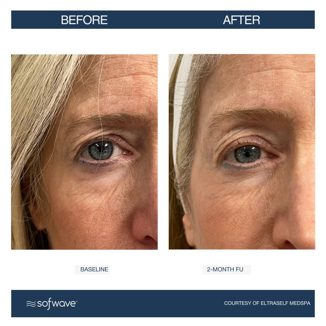 Advanced Eyebrow Lift