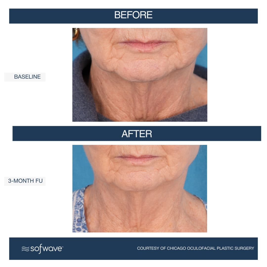 Neck Rejuvenation