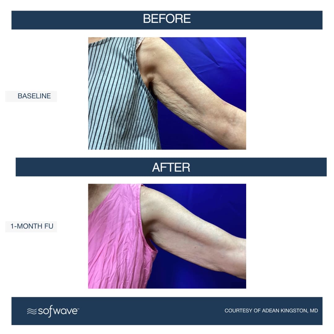 Upper Arms