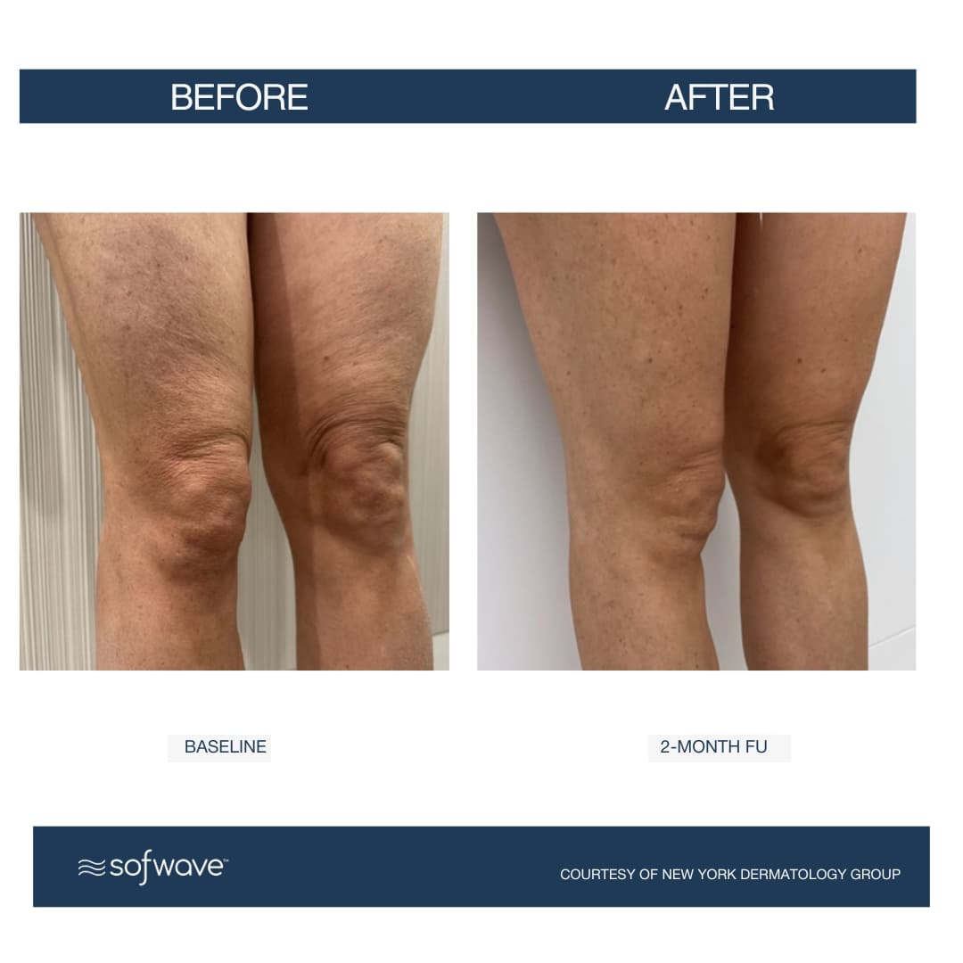 Cellulite Treatment
