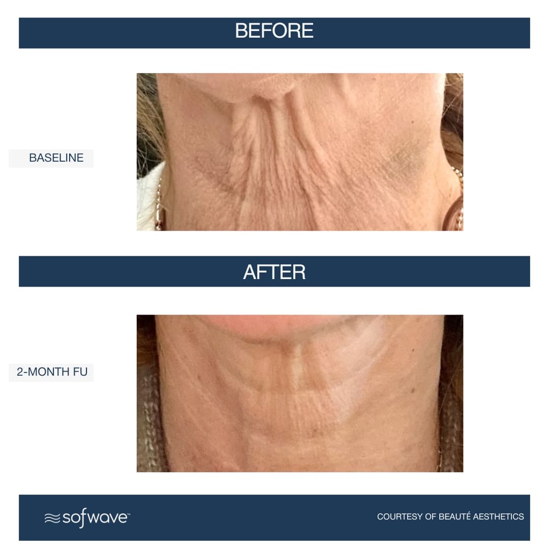 Neck Contouring