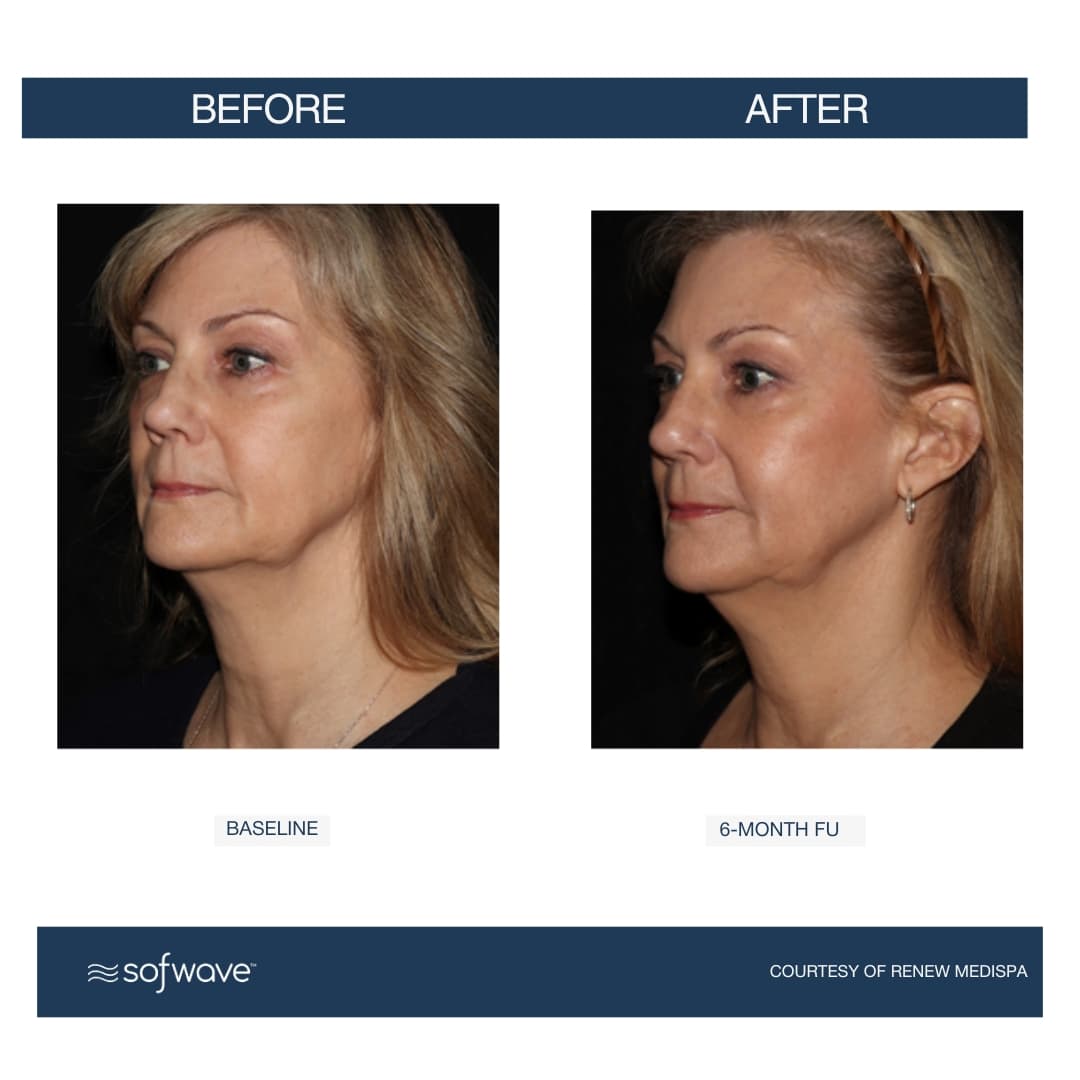Face & Neck Lift