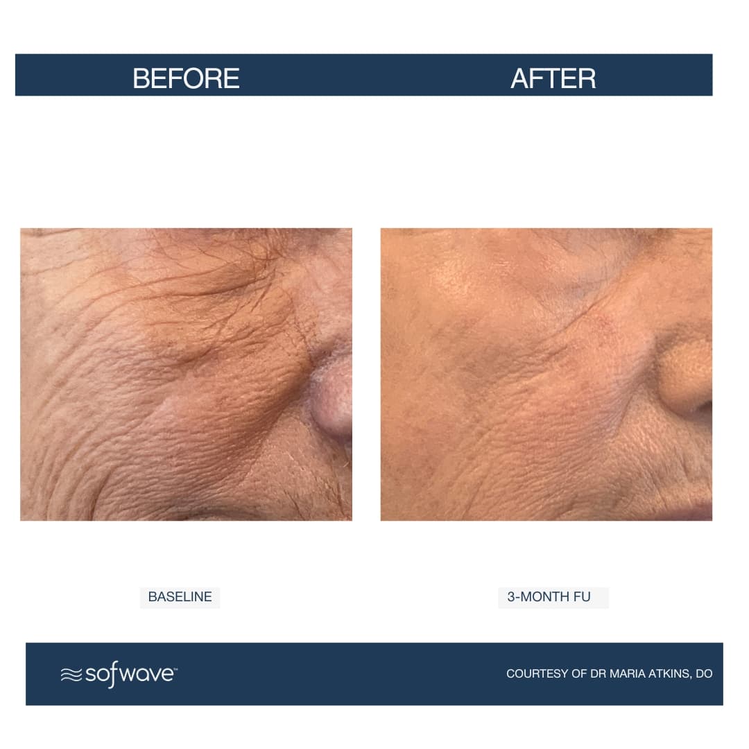 Under-Eye Rejuvenation