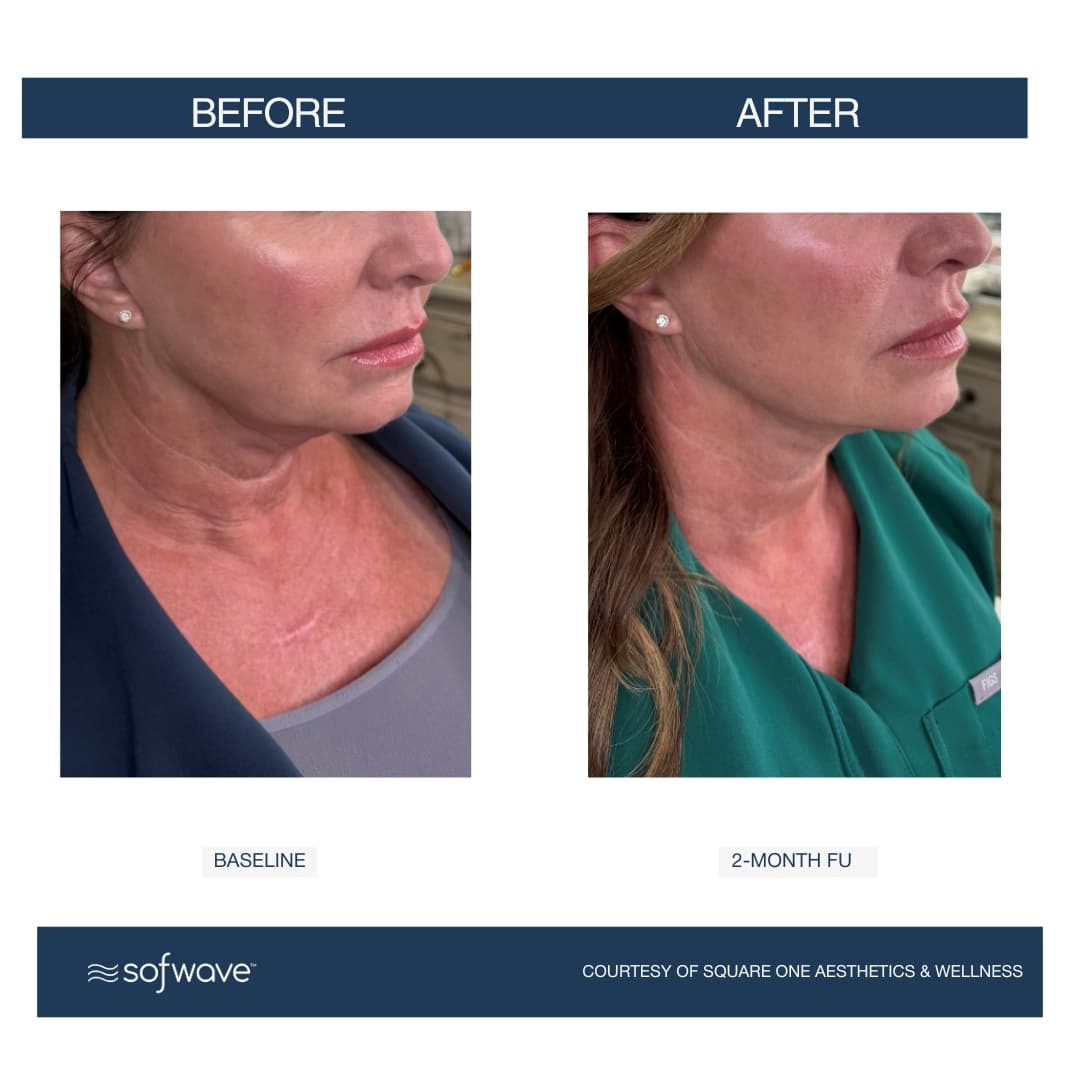 Neck Tightening