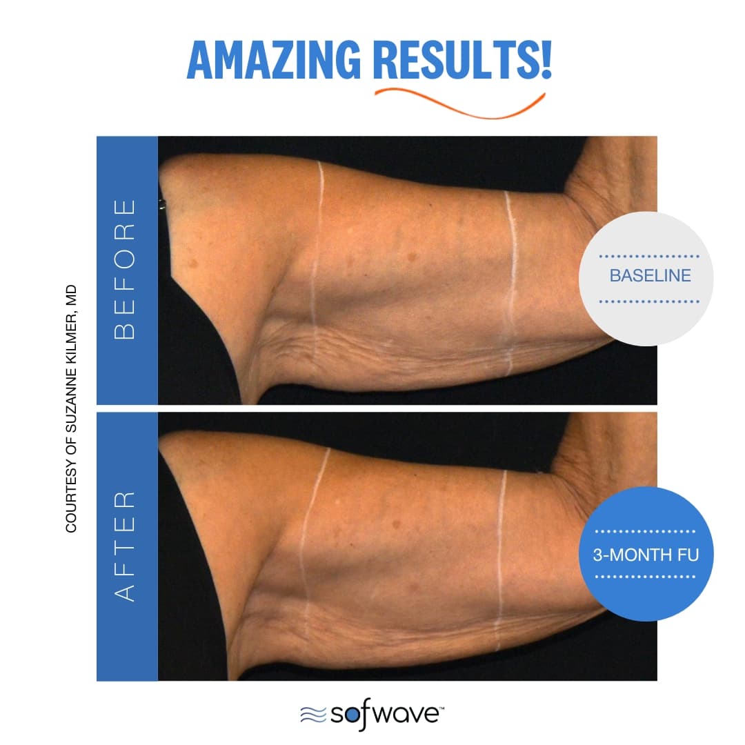 Upper Arm Treatment