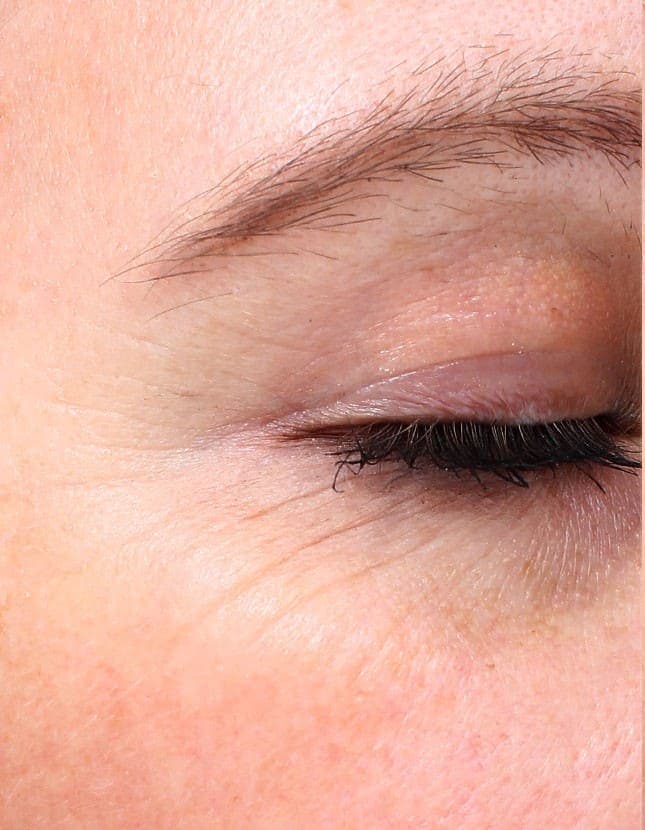 Before treatment