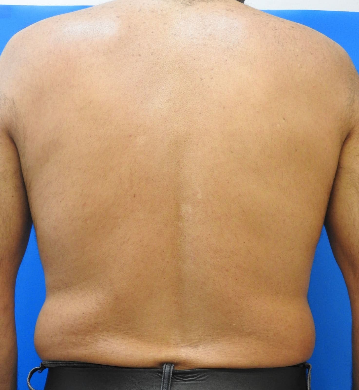 After treatment