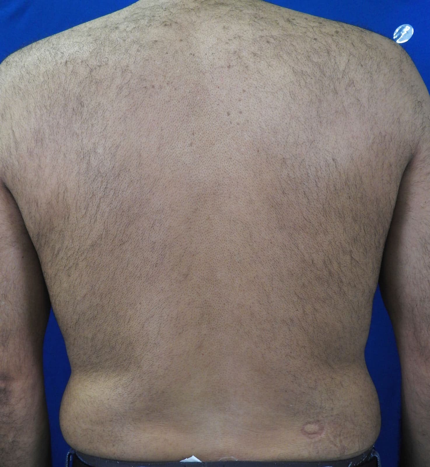 Before treatment