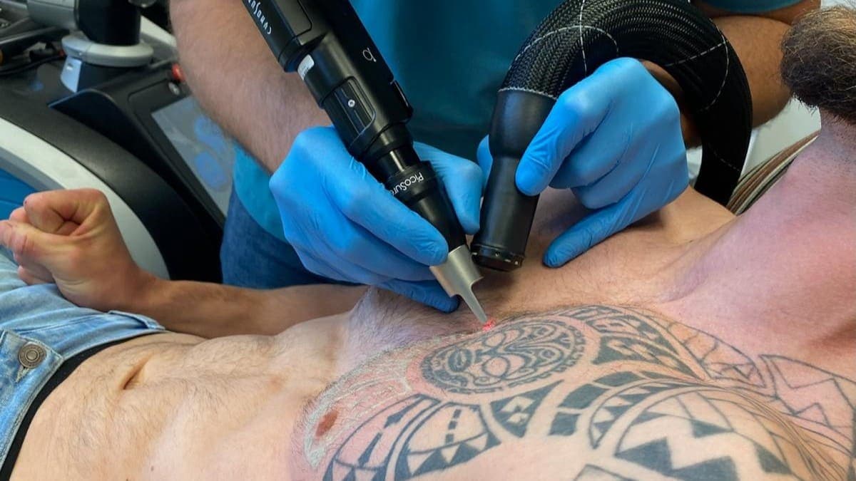 PicoSure Treatment