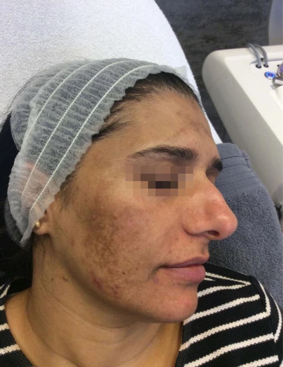 Before treatment