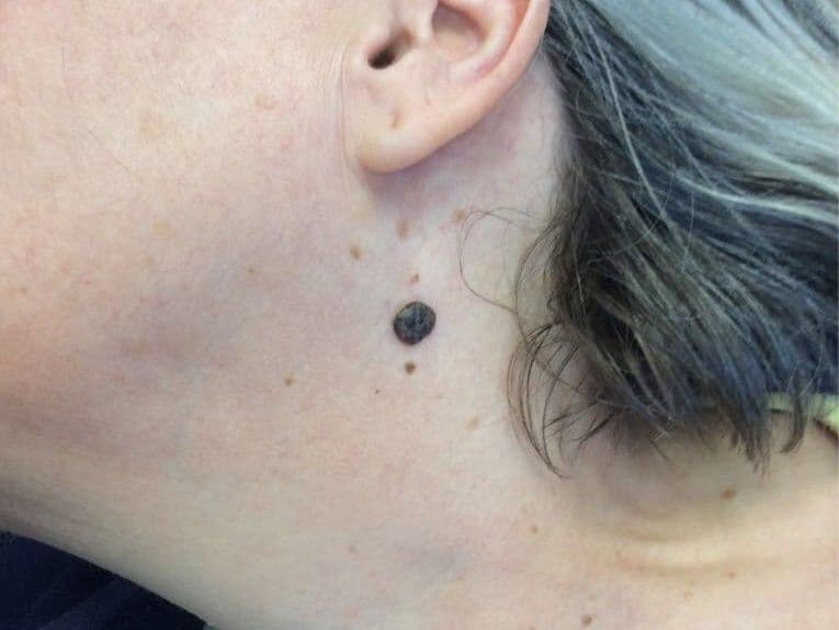 Before treatment