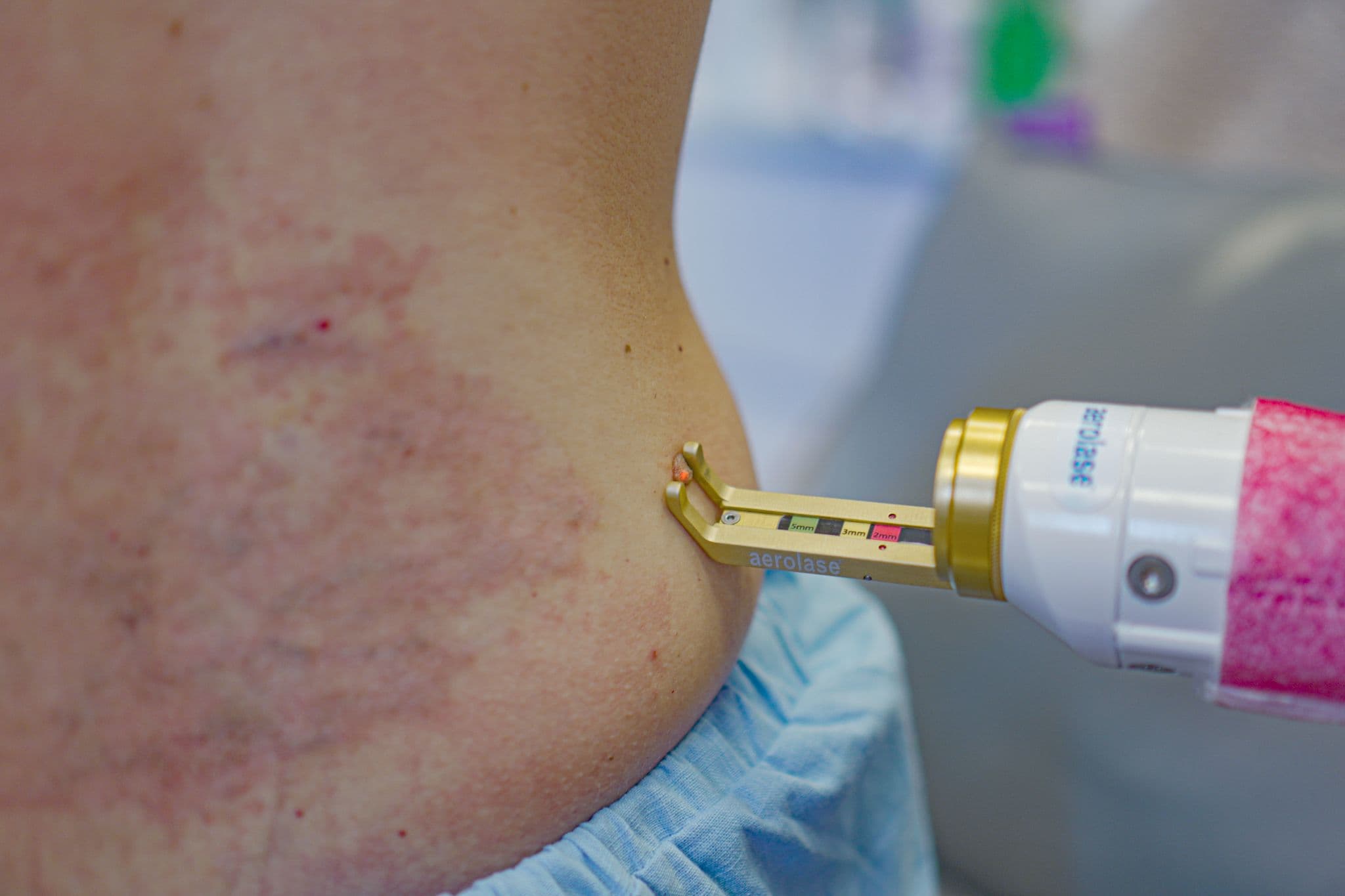 Skin Lesion Removal Treatment