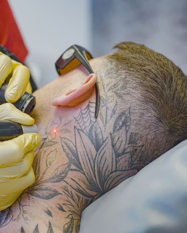 PicoSure Treatment