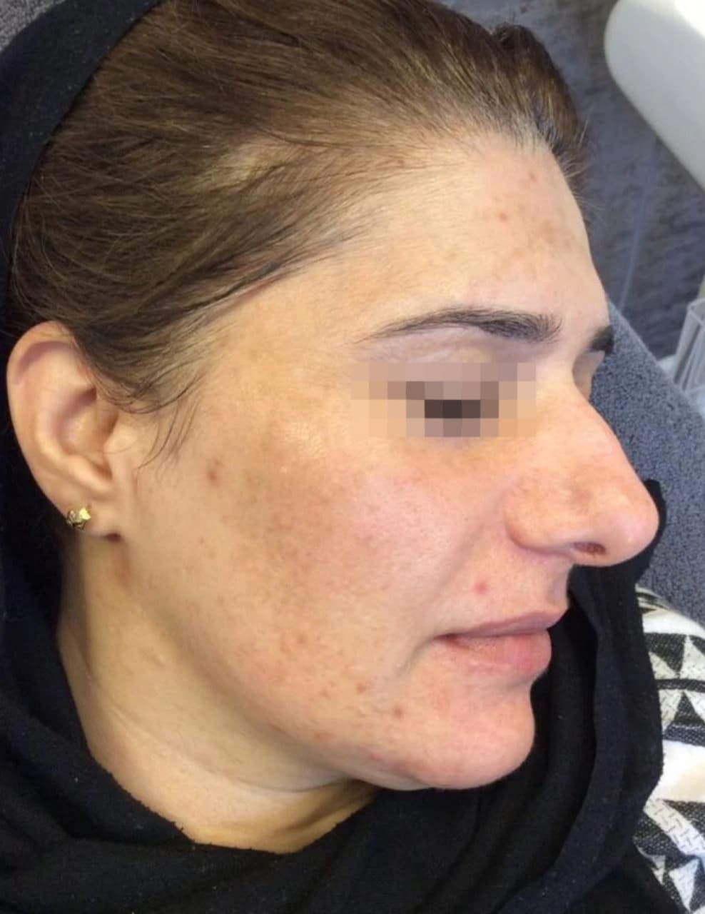 After treatment