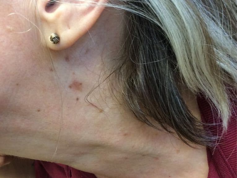 After treatment